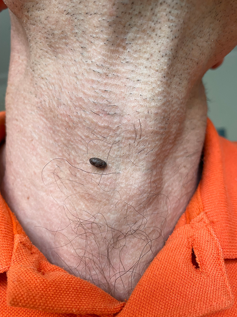 Skin treatment – Before