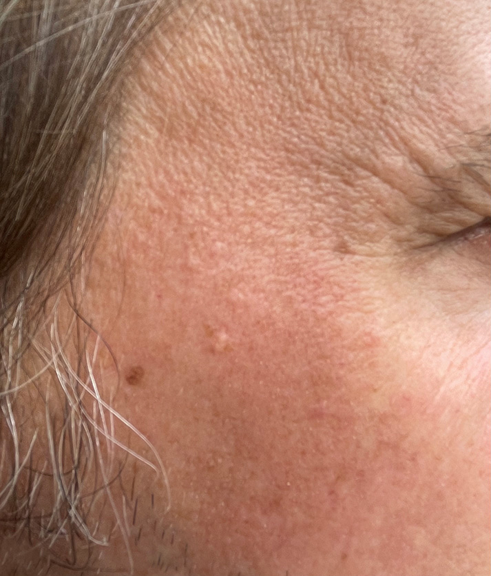 Treatment result