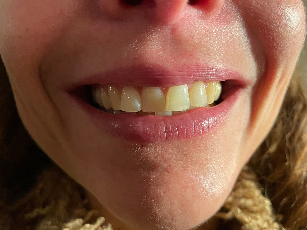 Skin treatment – Before