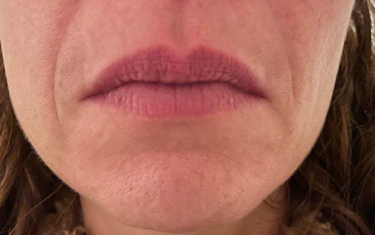 Skin treatment – After