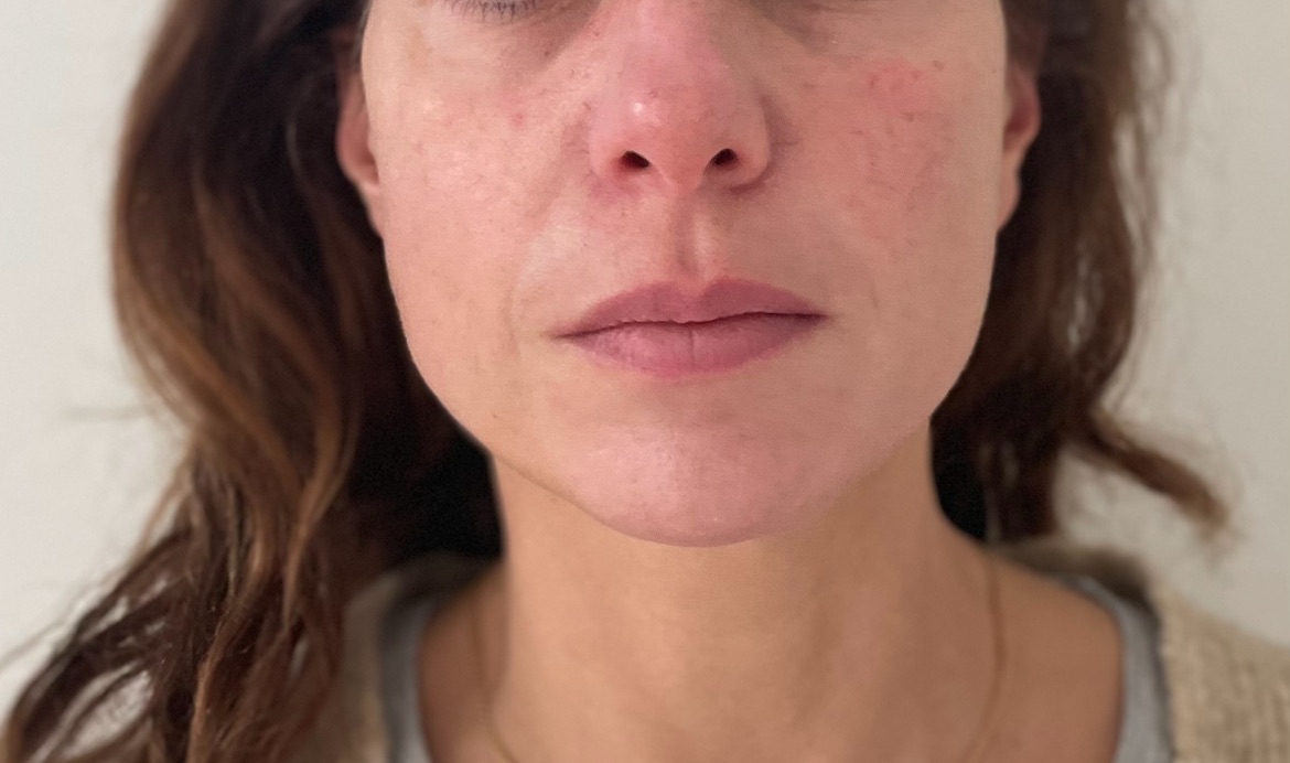 Treatment result