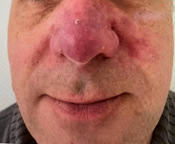 Skin treatment – Before