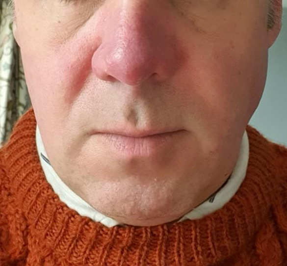 Skin treatment – After