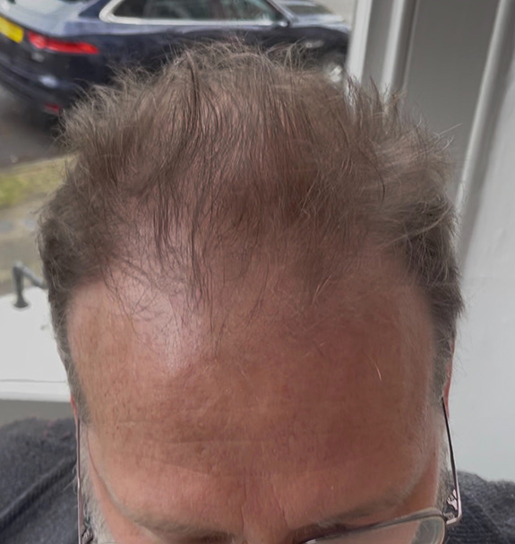 Hair regeneration – After treatment