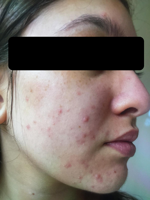 Patient 1 – Before treatment