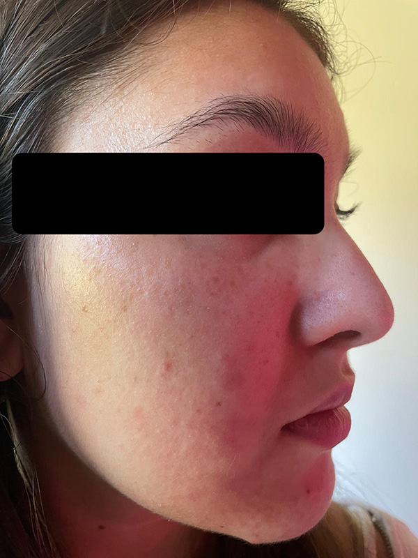 Patient 1 – After treatment
