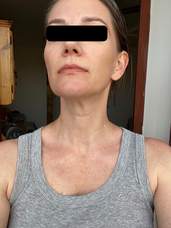 Patient 2 – After treatment