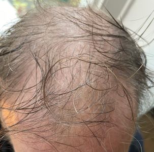 Before treatment result set 2