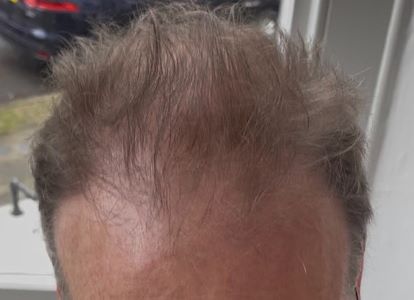 After treatment result set 2