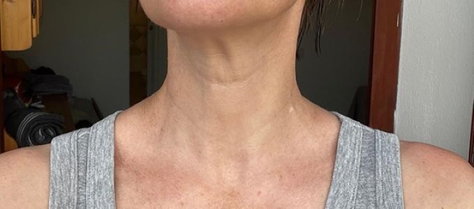 After treatment result set 3