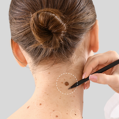 skin tag removal